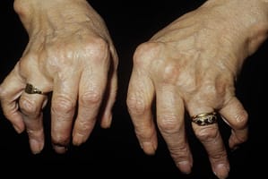 polyarthrite avancée