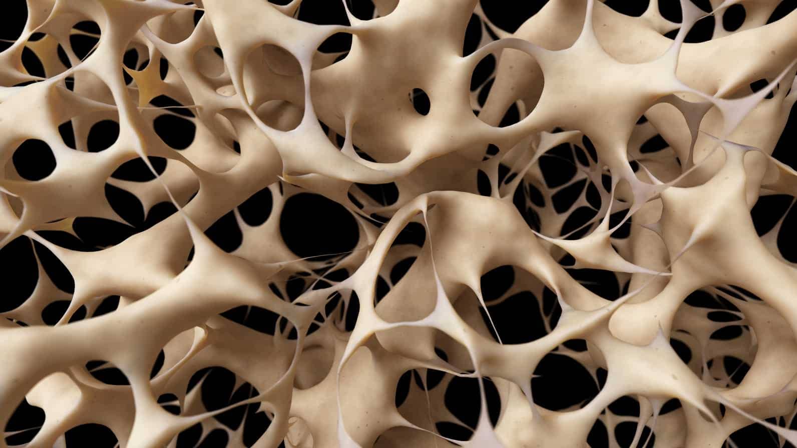 L'ostéoporose est une maladie caractérisée par une faible masse osseuse et la perte de tissus osseux qui peuvent conduire à des faiblesses et des fragilités des os.